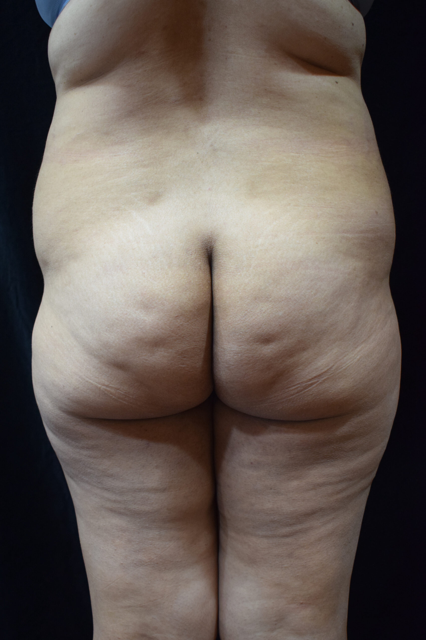 Back view of a young child’s torso and buttocks with natural skin folds, viewed from behind.