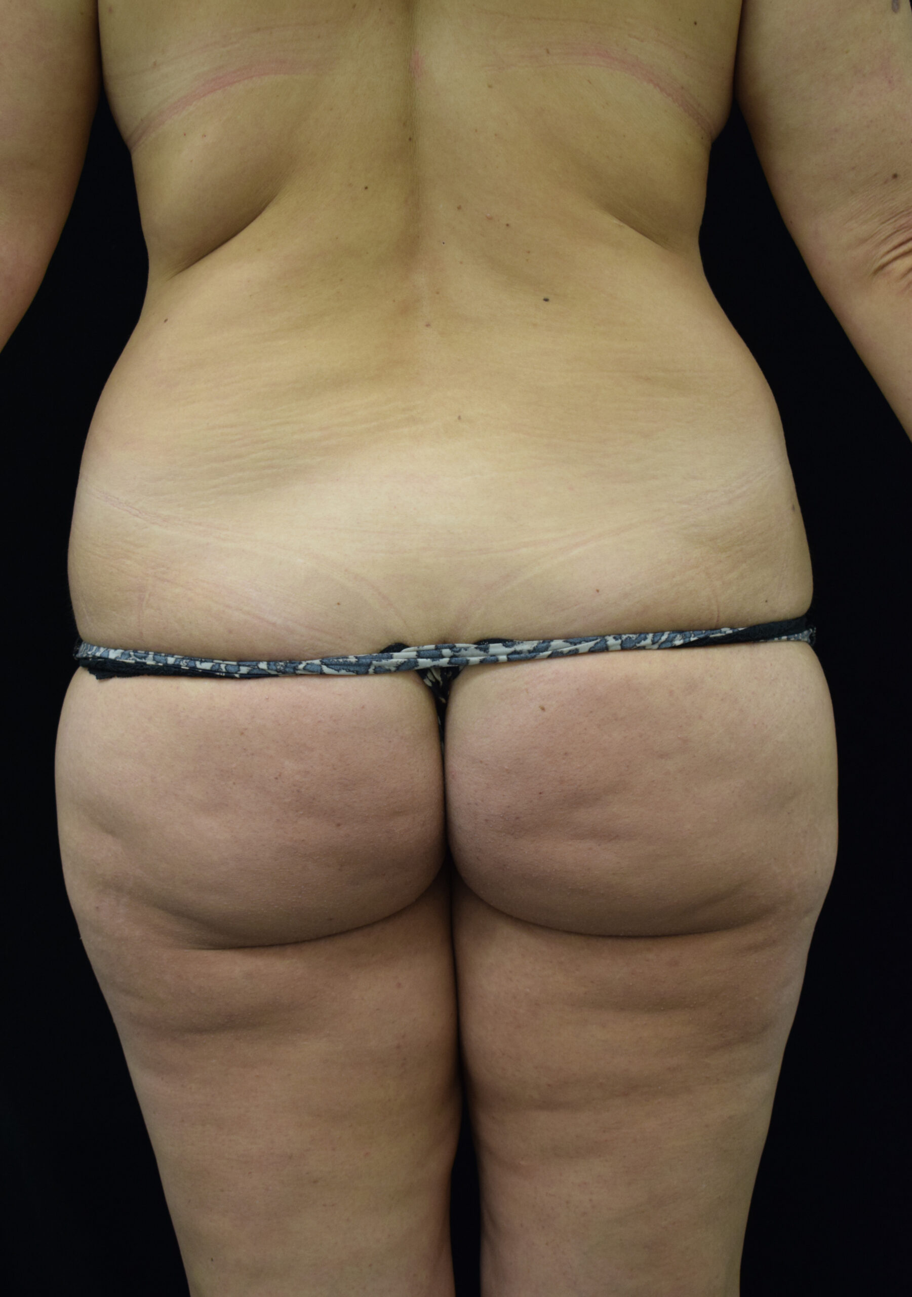 Back view of a person wearing a patterned bikini bottom, showing lower back, hips, and buttocks with faint stretch marks and skin folds.