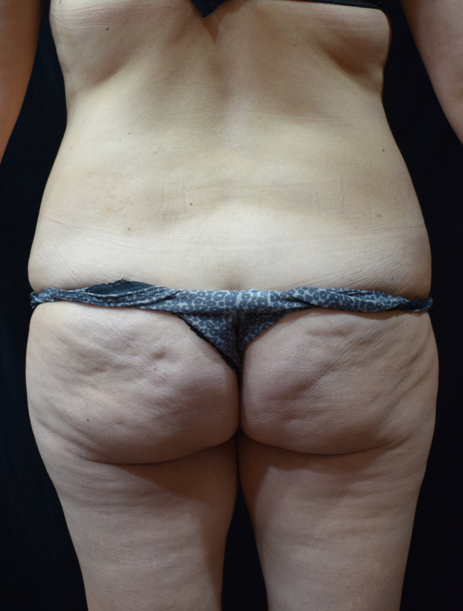 Rear view of a person wearing a patterned bikini bottom, exposing the lower back and buttocks against a dark background.