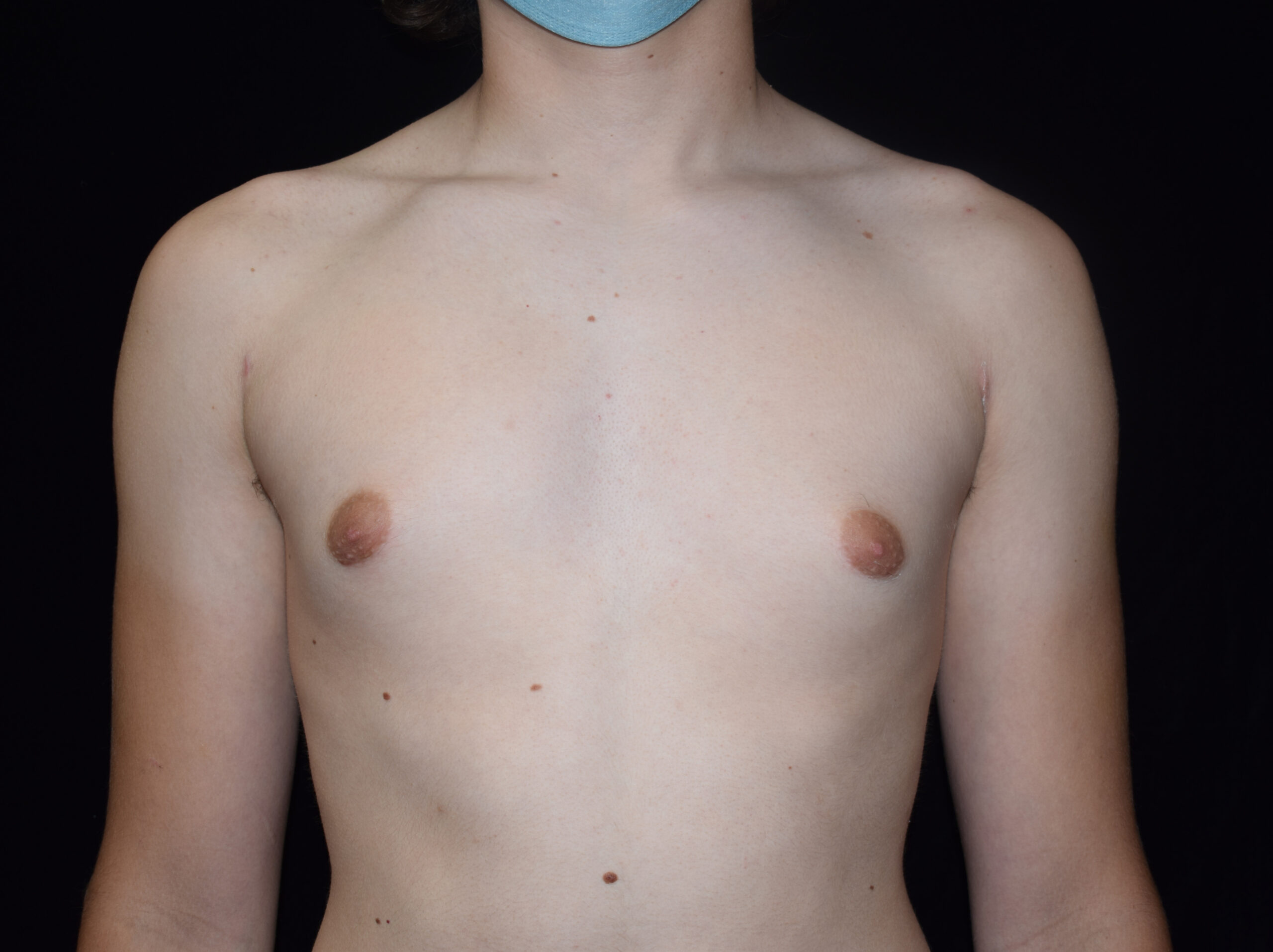 gynecomastia after - Dr. Joseph A. Racanelli Person seen from chest up, topless, wearing a blue face mask against a black background, facing forward.