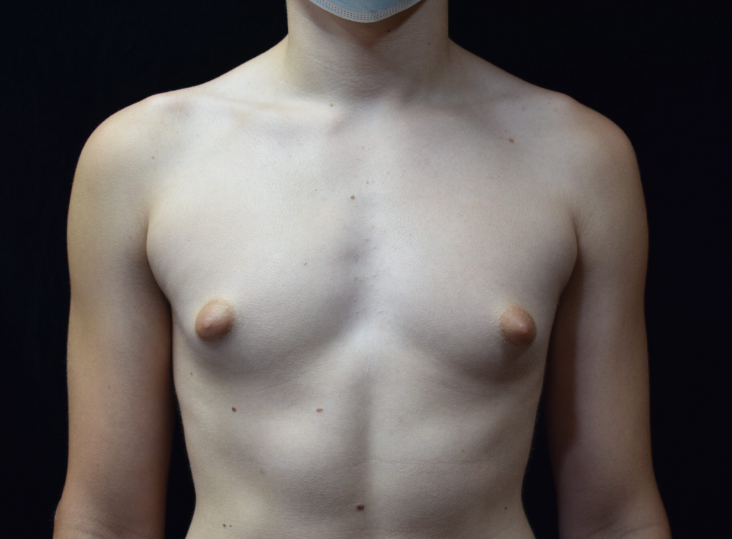 gynecomastia before - Dr. Joseph A. Racanelli Torso of a shirtless person with shoulders and collarbones visible against a dark background, a surgical mask resting under the chin.