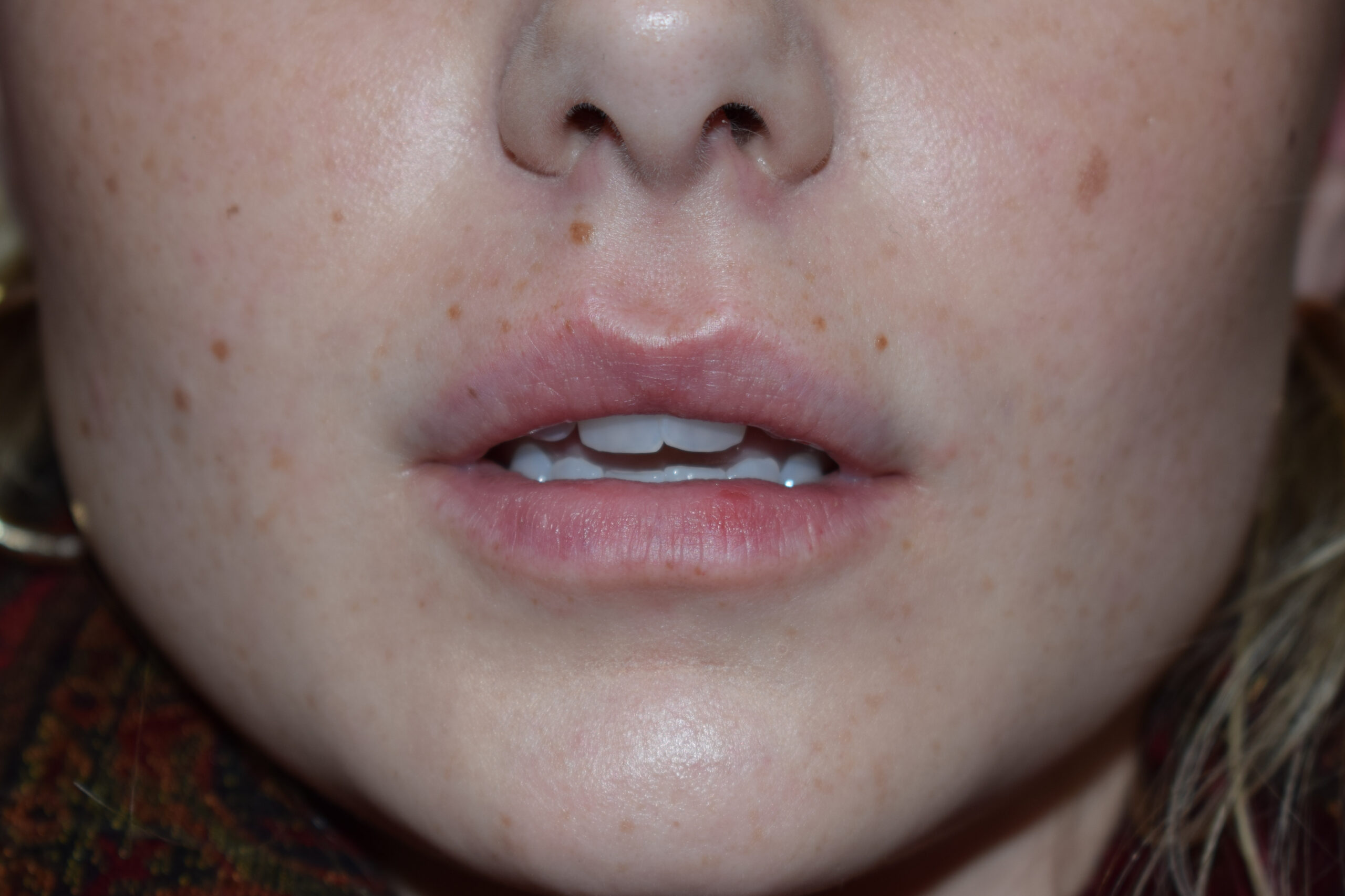 lip filler after - Dr. Joseph A. Racanelli Close-up of a smiling mouth with visible upper teeth and pink lips, freckled skin around the mouth and nose.