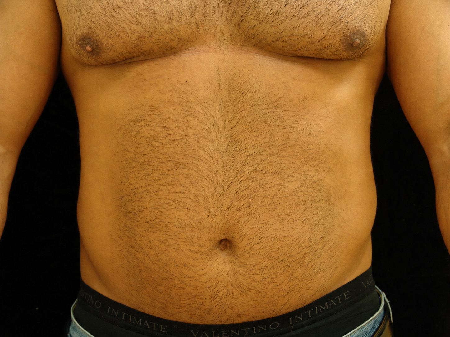 male liposuction - Dr. Joseph A. Racanelli Front view of a shirtless adult male torso with noticeable chest and abdominal hair, waistband showing 'VALENTINO INTIMATE'.