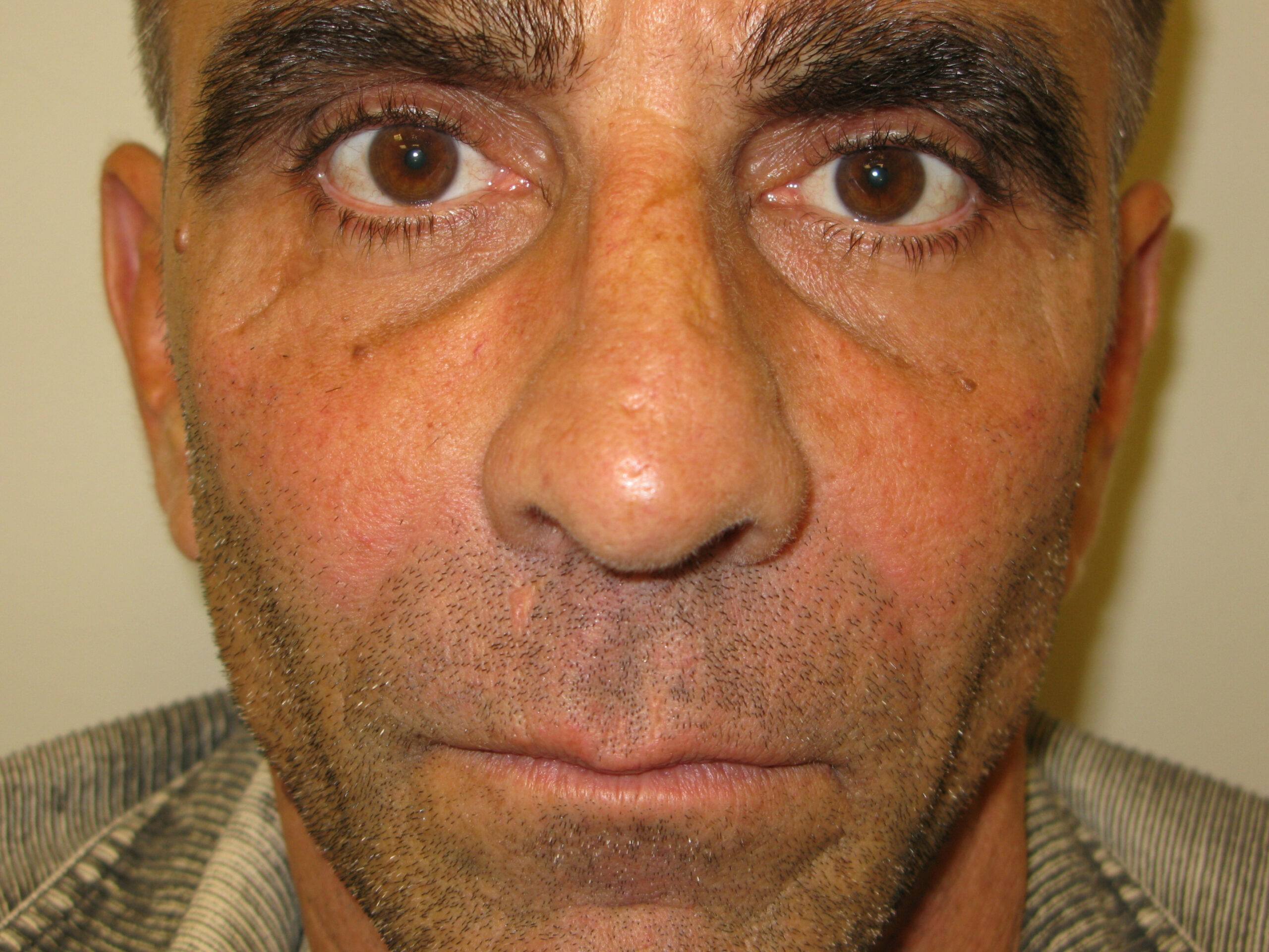 nasolabial folds after - Dr. Joseph A. Racanelli Close-up of a man's face showing eyes, nose, and light stubble.