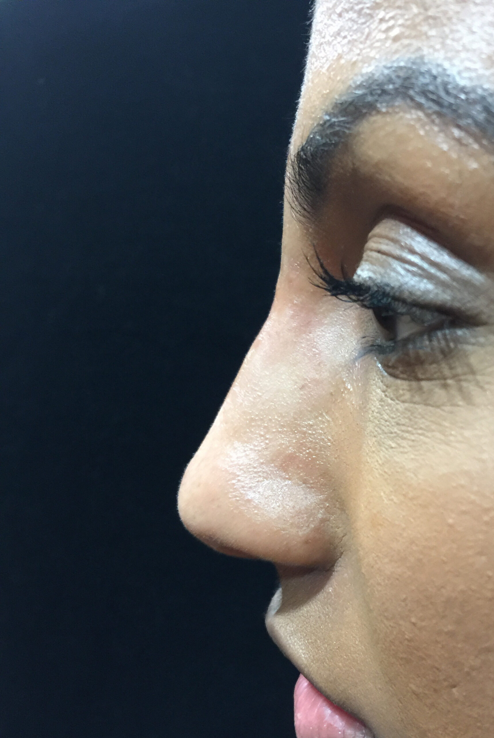 nonsurgical rhino after - Dr. Joseph A. Racanelli Close-up side profile of a person with their eye closed, showing the eyelid, nose, and lips against a dark background.