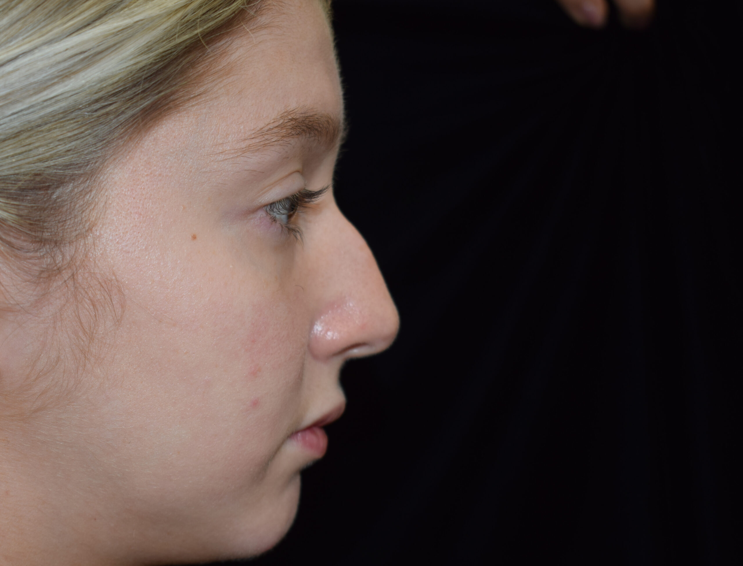 rhinoplasty before - Dr. Joseph A. Racanelli before-after-rhinoplasty-11c