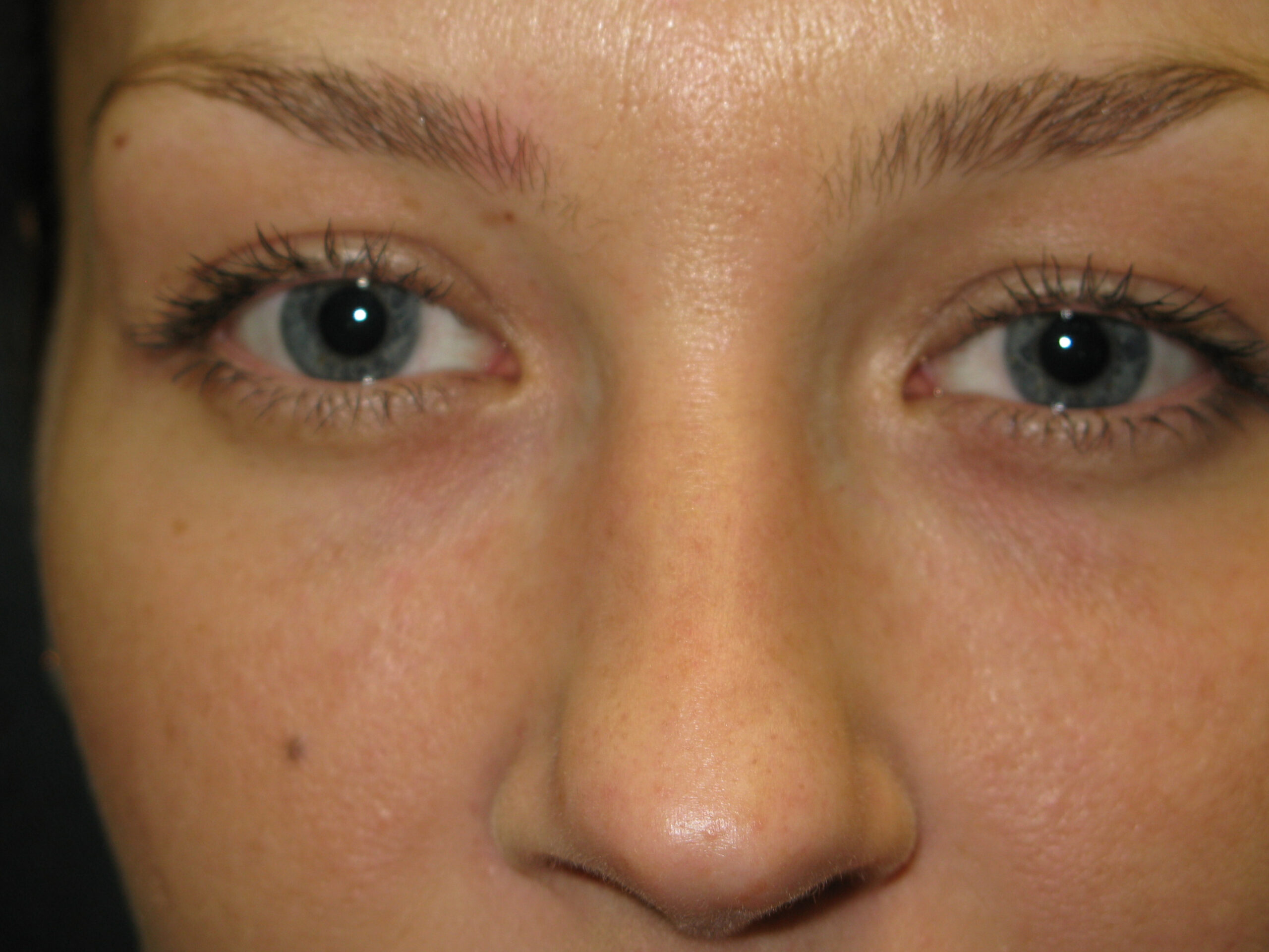 tear trough after - Dr. Joseph A. Racanelli Close-up of a person’s face around the eyes: blue-gray irises, long lashes, and smooth skin visible near the nose bridge.