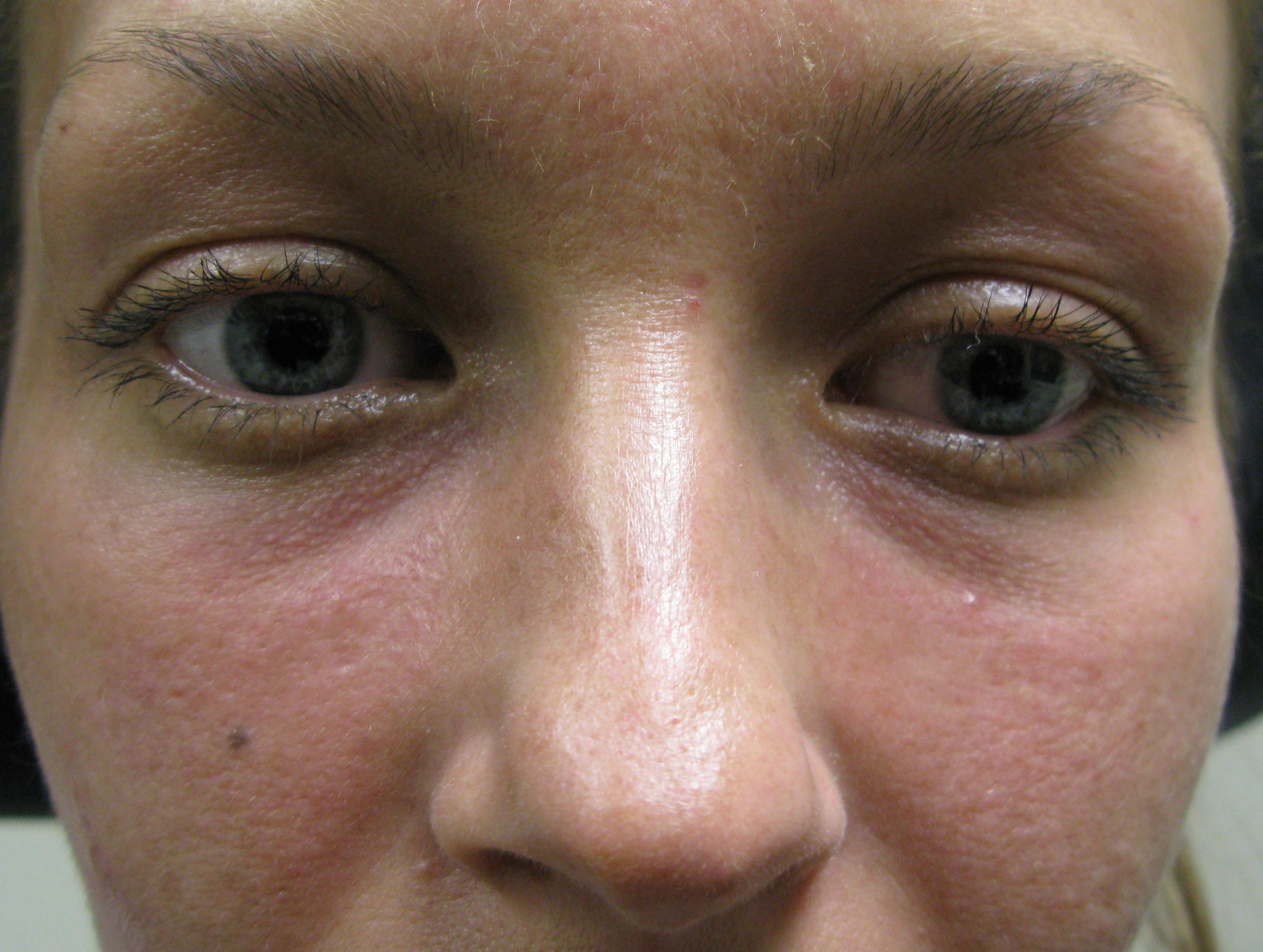 tear trough before - Dr. Joseph A. Racanelli Close-up of a person’s face focusing on the eyes and nose, with one eye partly closed.