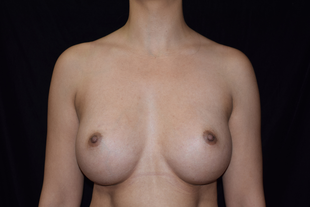 breast-augmentation-25B - Dr. Joseph A. Racanelli Front view of a topless adult woman's bare chest and shoulders against a dark background.