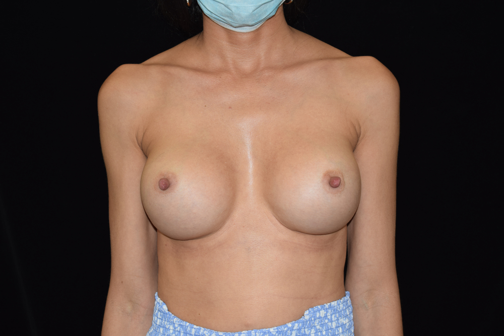 breast-augmentation-26B - Dr. Joseph A. Racanelli Front view of a topless adult woman from shoulders to waist, wearing blue patterned shorts and a mask, against a black background.