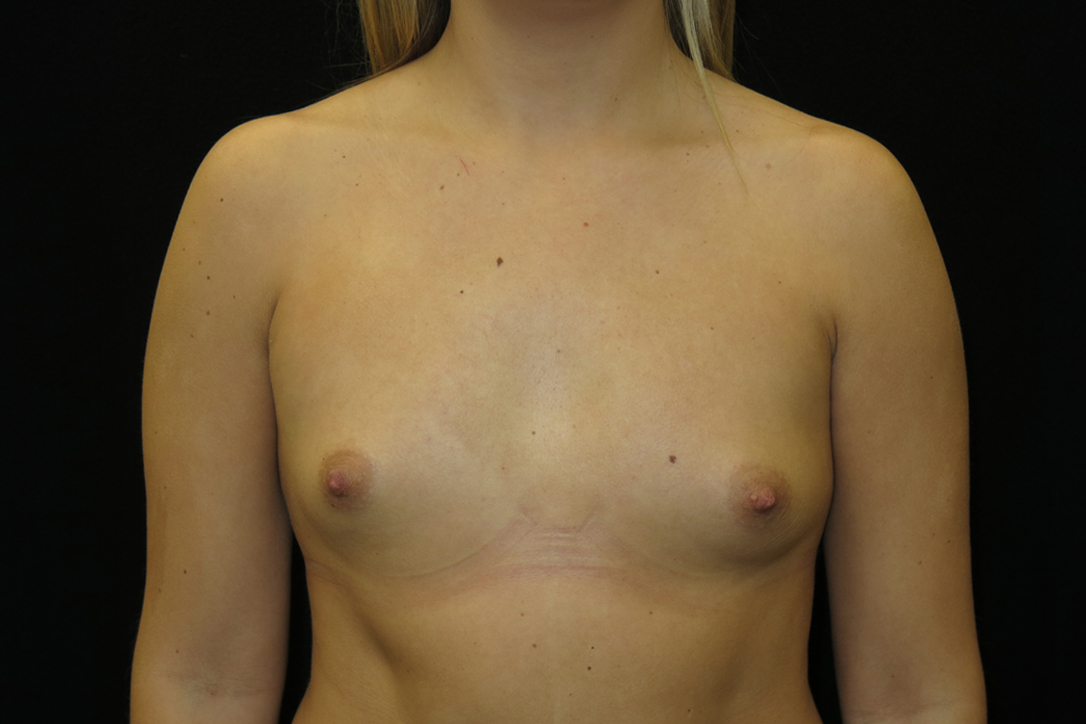 breast-augmentation-36A - Dr. Joseph A. Racanelli Front view of a topless adult woman’s torso against a black background, showing breasts and nipples (medical documentation).
