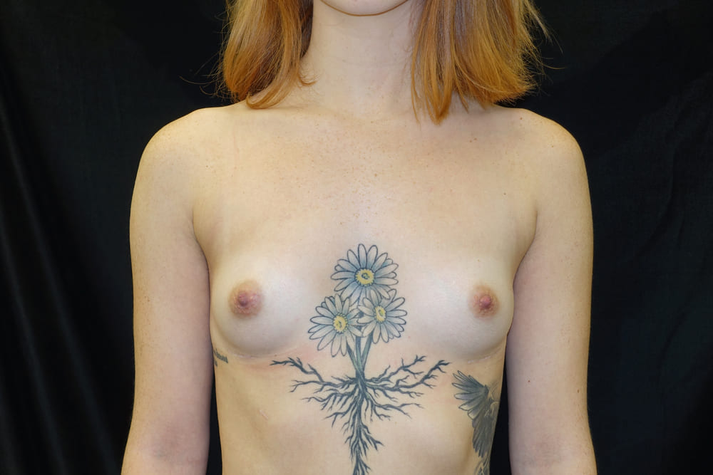 breast-augmentation-12A - Dr. Joseph A. Racanelli Topless person with a tattoo of three daisies connected by a root-like stem centered on the chest between the breasts.