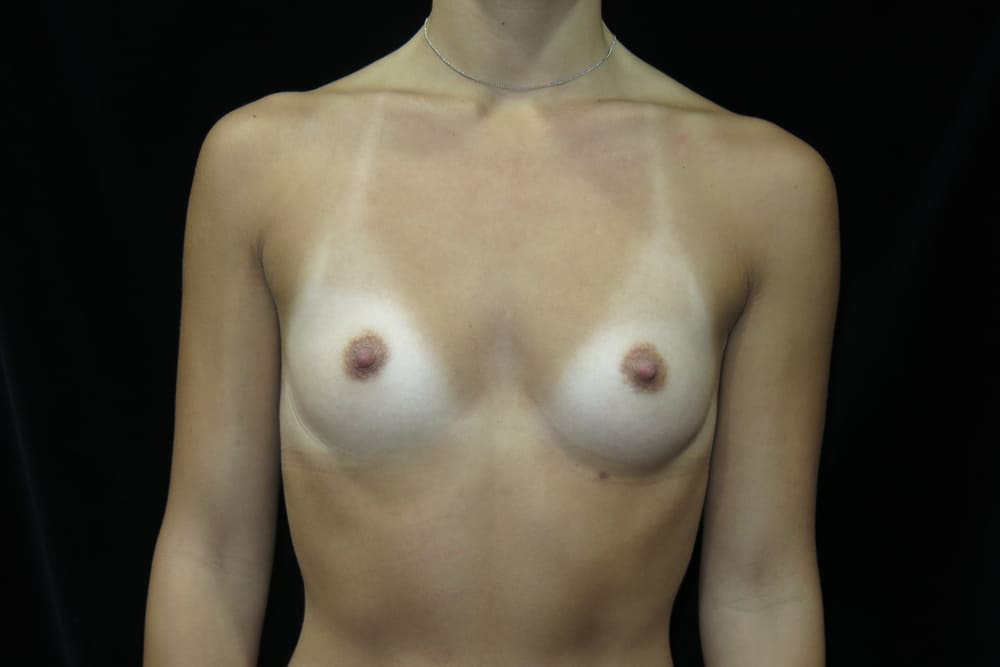 breast-augmentation-13A - Dr. Joseph A. Racanelli Front view of a topless person’s torso wearing a thin necklace against a black background.