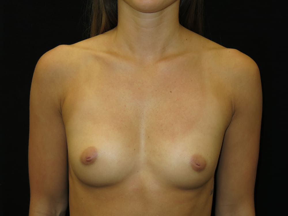 breast-augmentation-14A - Dr. Joseph A. Racanelli Front view of a topless adult woman showing her breasts and chest for medical documentation or assessment of breasts and torso.