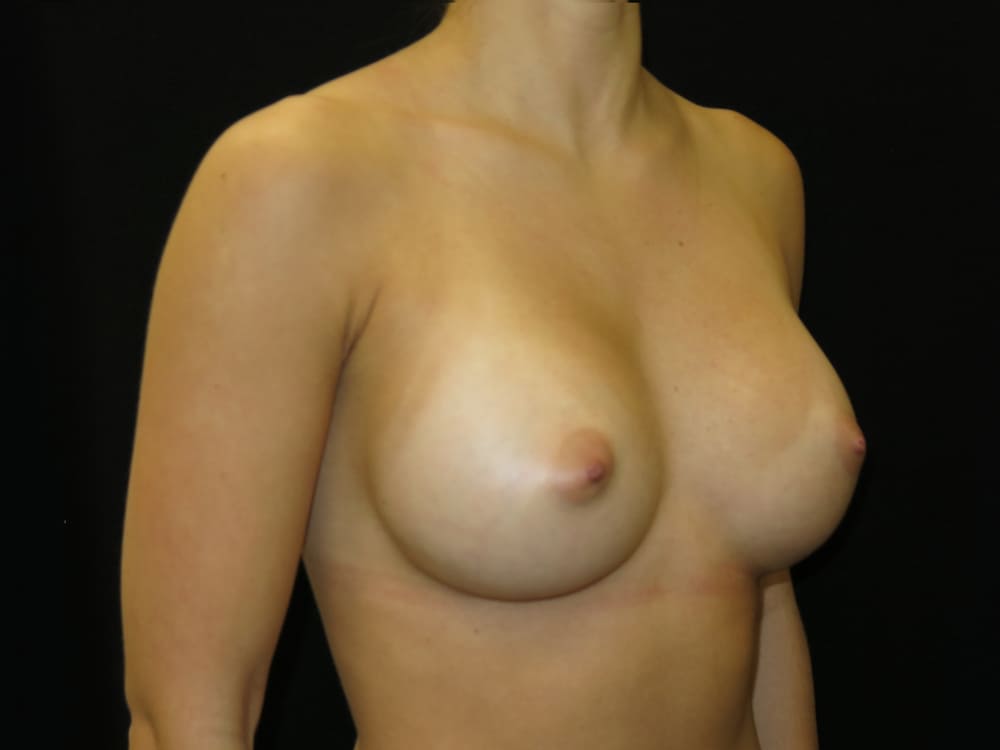 breast-augmentation-14H - Dr. Joseph A. Racanelli Side view of an adult woman's topless chest against a black background.