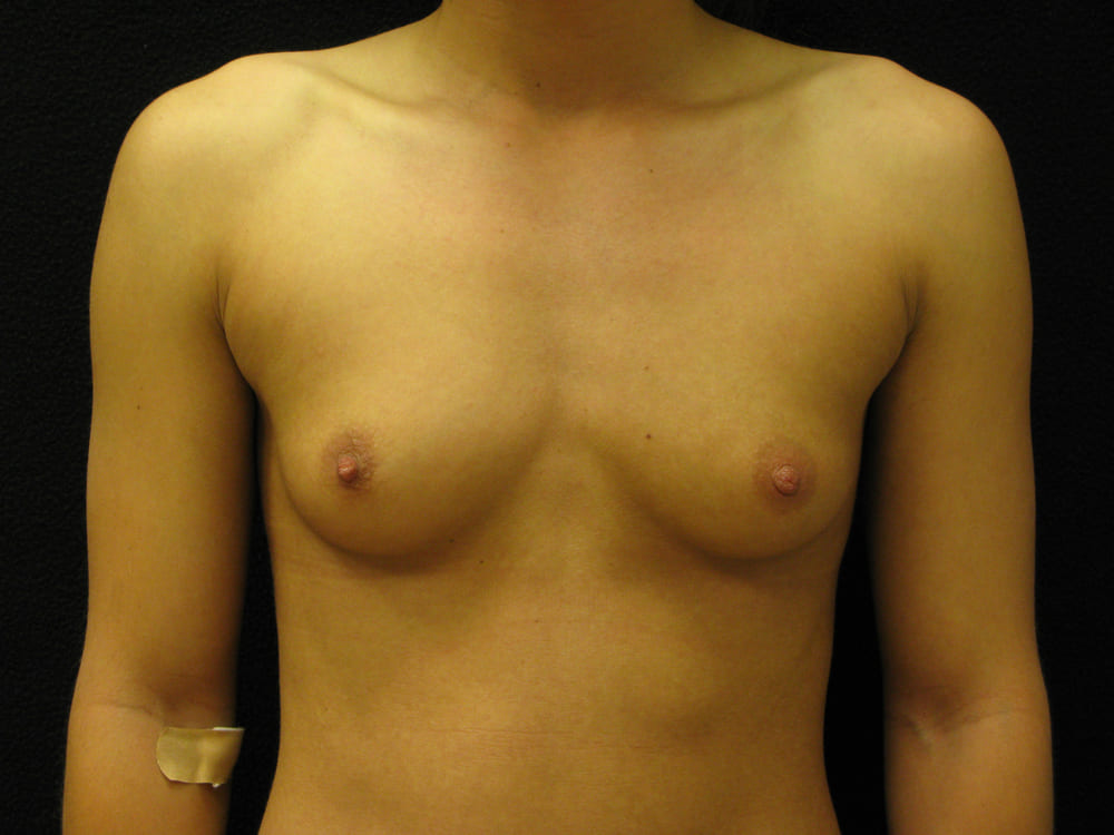 breast-augmentation-9A - Dr. Joseph A. Racanelli Front view of a topless person showing both breasts; adhesive bandage on the left upper arm against a dark background.