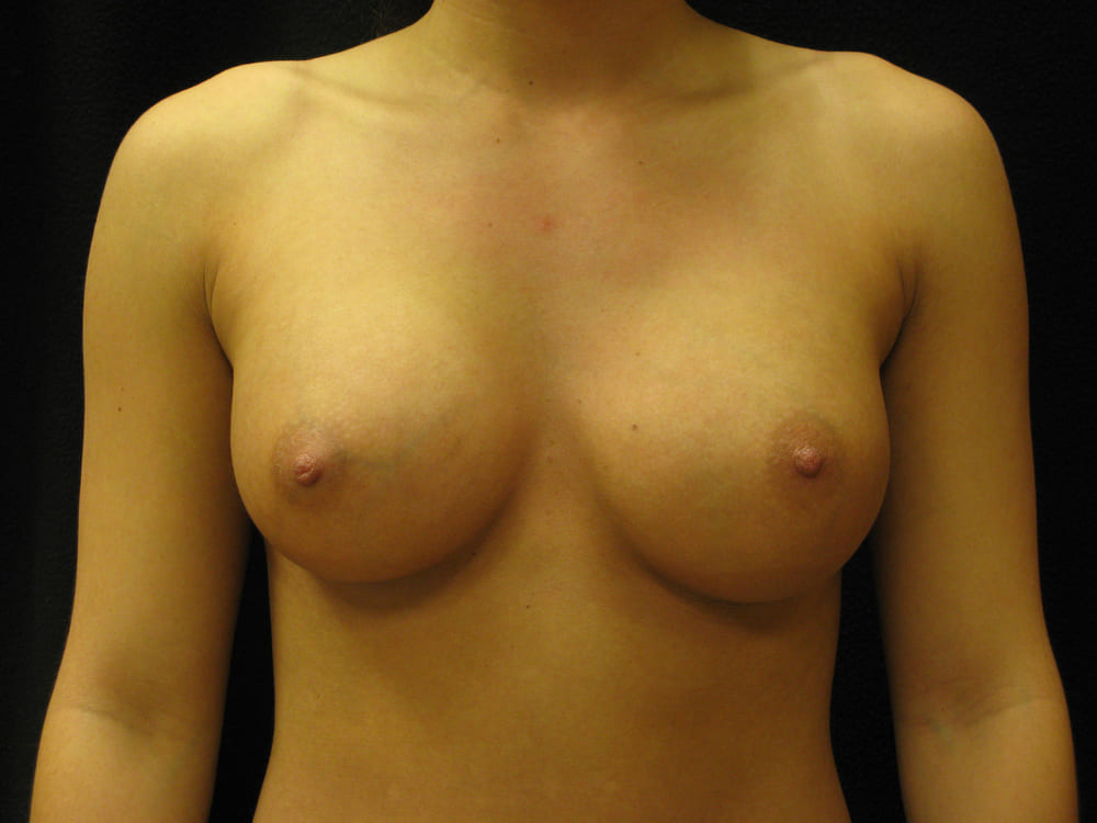 breast-augmentation-9B - Dr. Joseph A. Racanelli Front view of a woman's bare chest from neck to waist against a dark background, showing her breasts and nipples.