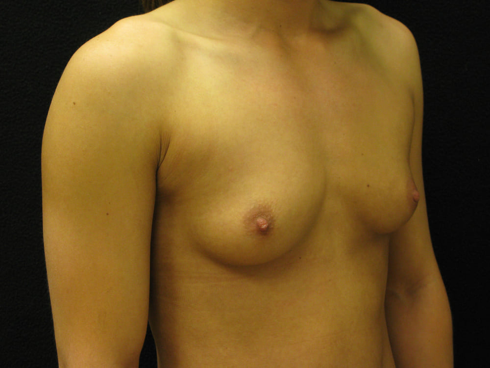 breast-augmentation-9C - Dr. Joseph A. Racanelli Side view of a topless female torso against a dark background, showing the right breast and left breast partially visible.