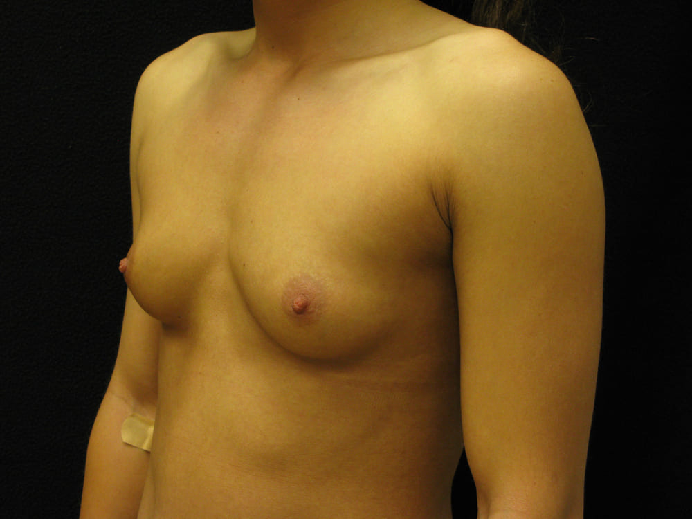 breast-augmentation-9G - Dr. Joseph A. Racanelli Side view of a topless woman showing her bare chest with visible left breast and a small bandage on the left upper arm, against a dark background (medical context).