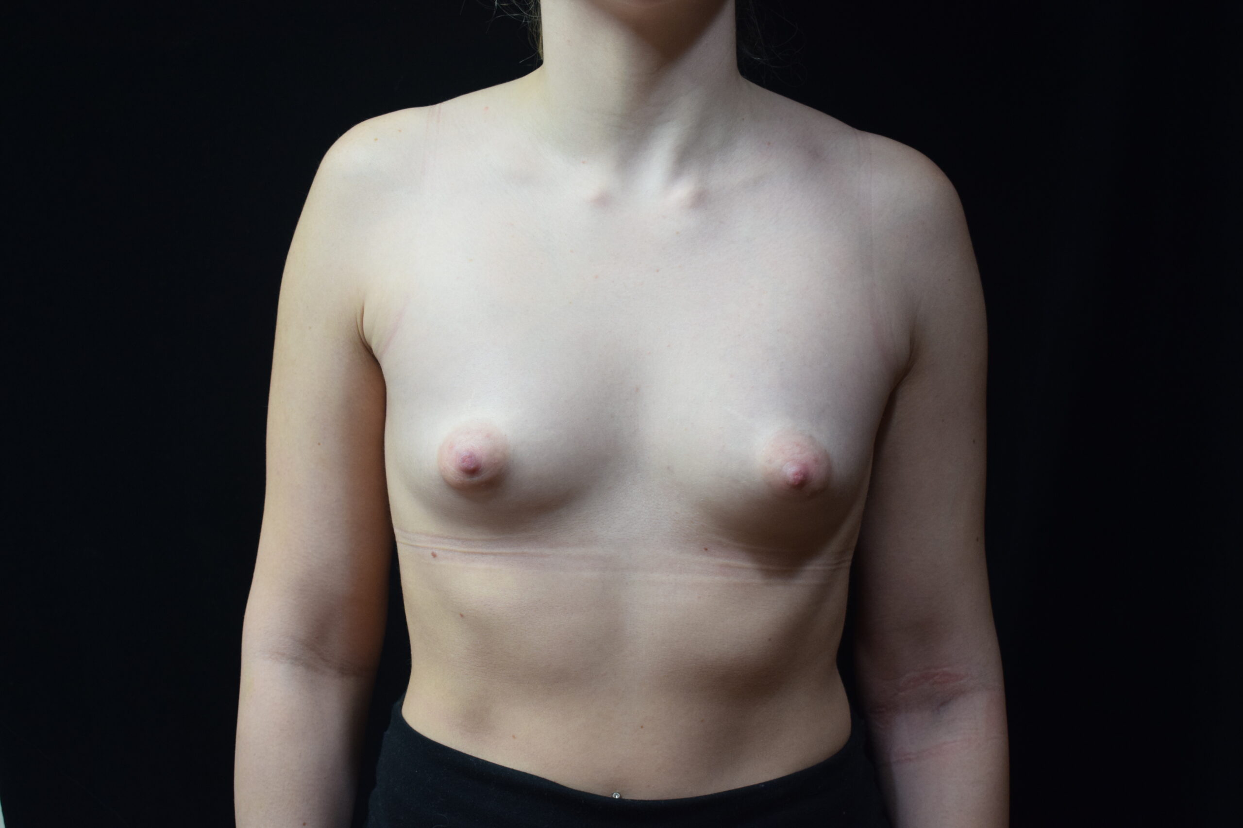 Breast augmentation Before Front - Dr. Joseph A. Racanelli Female patient before breast augmentation