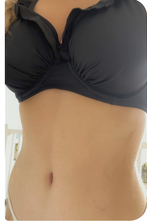 patient selfie mommy makeover - Dr. Joseph A. Racanelli female in a bikini