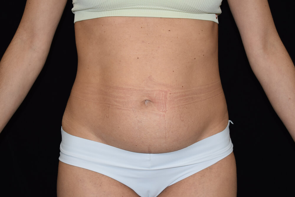 Tummy Tuck (abdominoplasty) - Dr. Joseph A. Racanelli Tummy Tuck (abdominoplasty)