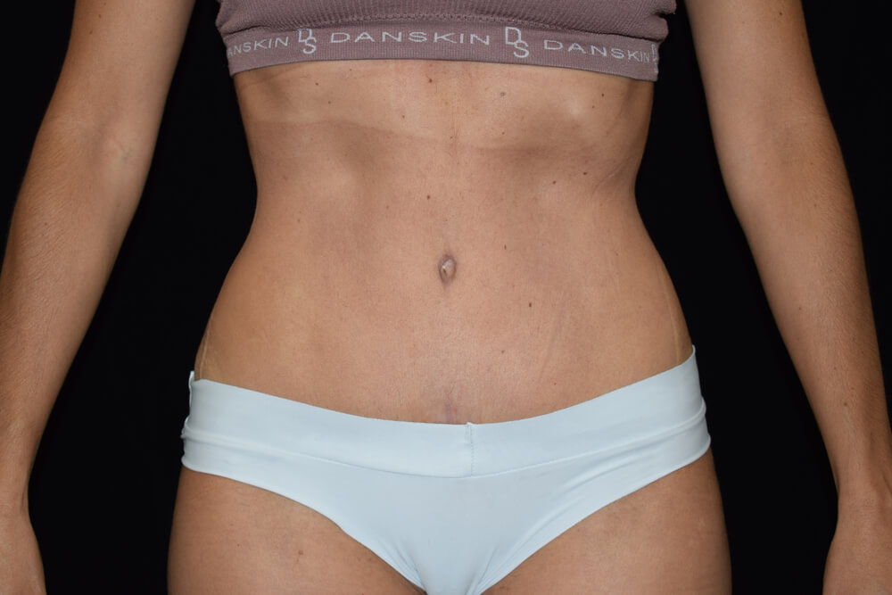 Tummy Tuck (abdominoplasty) - Dr. Joseph A. Racanelli Tummy Tuck (abdominoplasty)