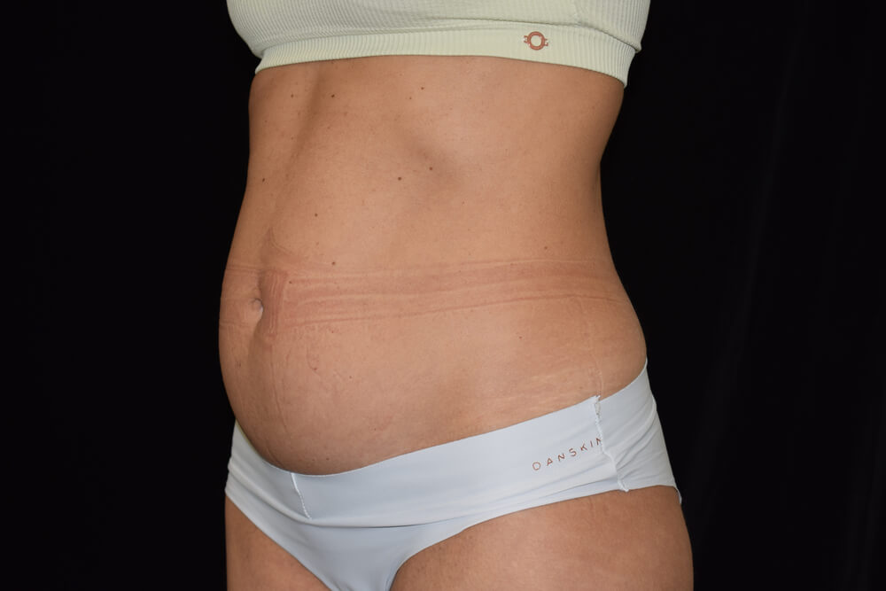Tummy Tuck (abdominoplasty) - Dr. Joseph A. Racanelli Tummy Tuck (abdominoplasty)