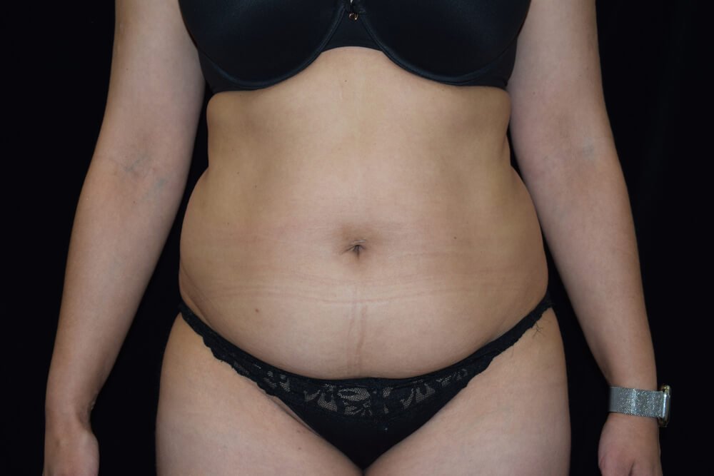 Tummy Tuck (abdominoplasty) - Dr. Joseph A. Racanelli Tummy Tuck (abdominoplasty)