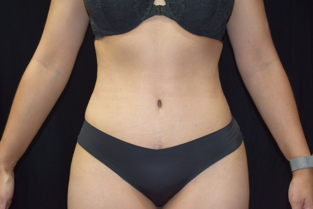 Tummy Tuck (abdominoplasty) - Dr. Joseph A. Racanelli Tummy Tuck (abdominoplasty)