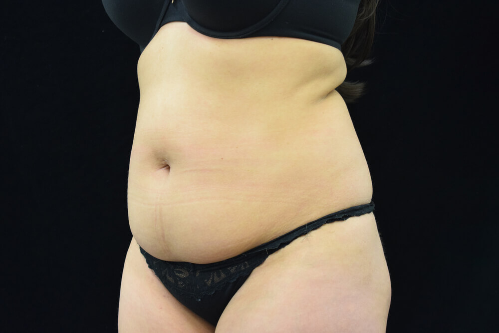 Tummy Tuck (abdominoplasty) - Dr. Joseph A. Racanelli Tummy Tuck (abdominoplasty)
