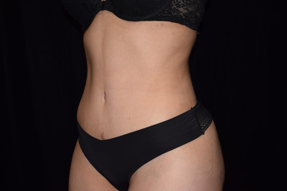 Tummy Tuck (abdominoplasty) - Dr. Joseph A. Racanelli Tummy Tuck (abdominoplasty)