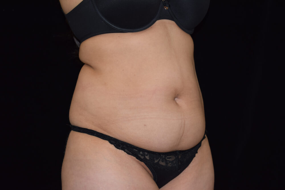 Tummy Tuck (abdominoplasty) - Dr. Joseph A. Racanelli Tummy Tuck (abdominoplasty)