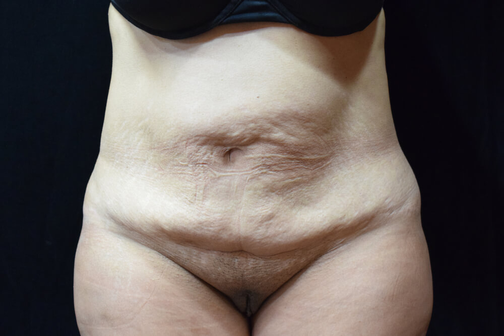 Tummy Tuck (abdominoplasty) - Dr. Joseph A. Racanelli Tummy Tuck (abdominoplasty)