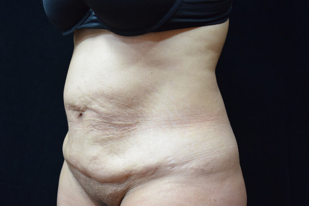 Tummy Tuck (abdominoplasty) - Dr. Joseph A. Racanelli Tummy Tuck (abdominoplasty)
