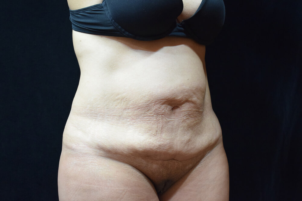 Tummy Tuck (abdominoplasty) - Dr. Joseph A. Racanelli Tummy Tuck (abdominoplasty)