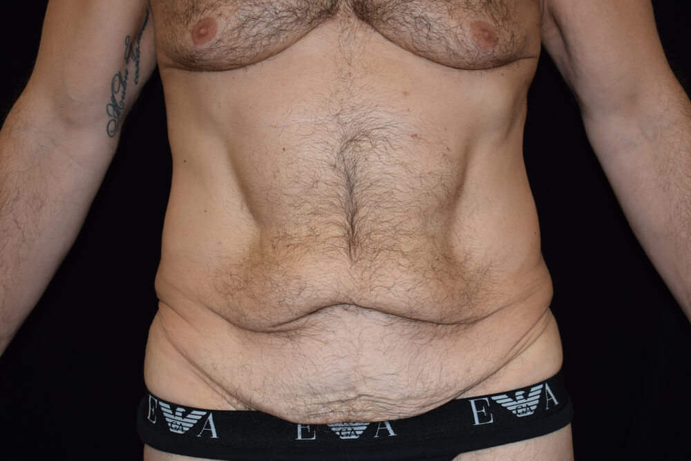 Tummy Tuck (abdominoplasty) - Dr. Joseph A. Racanelli Tummy Tuck (abdominoplasty)