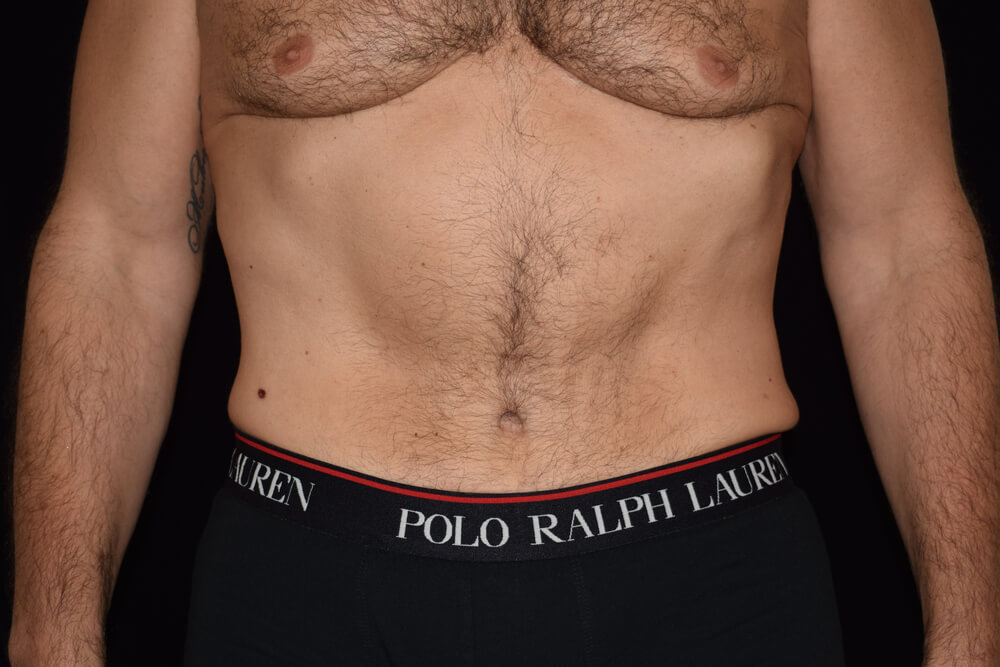 Tummy Tuck (abdominoplasty) - Dr. Joseph A. Racanelli Tummy Tuck (abdominoplasty)