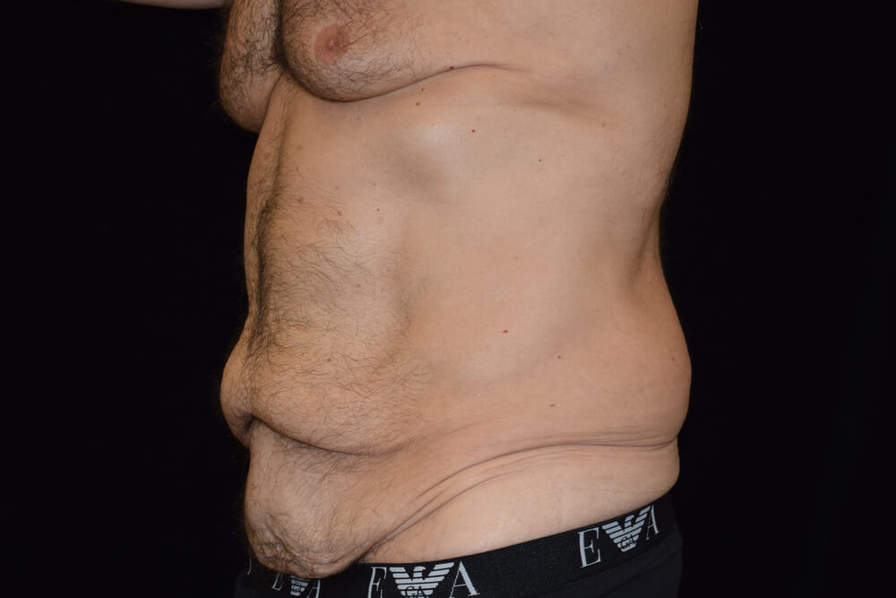 Tummy Tuck (abdominoplasty) - Dr. Joseph A. Racanelli Tummy Tuck (abdominoplasty)