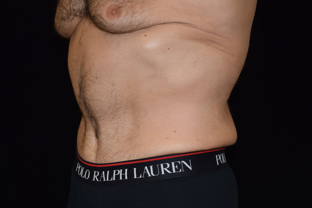 Tummy Tuck (abdominoplasty) - Dr. Joseph A. Racanelli Tummy Tuck (abdominoplasty)