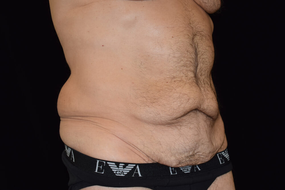 Tummy Tuck (abdominoplasty) - Dr. Joseph A. Racanelli Tummy Tuck (abdominoplasty)