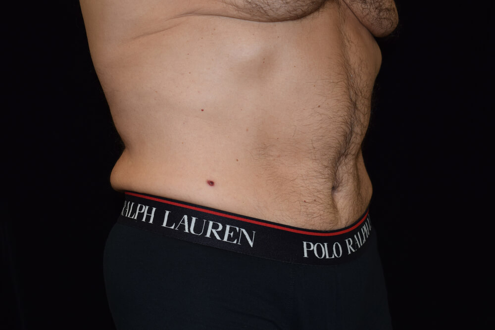 Tummy Tuck (abdominoplasty) - Dr. Joseph A. Racanelli Tummy Tuck (abdominoplasty)