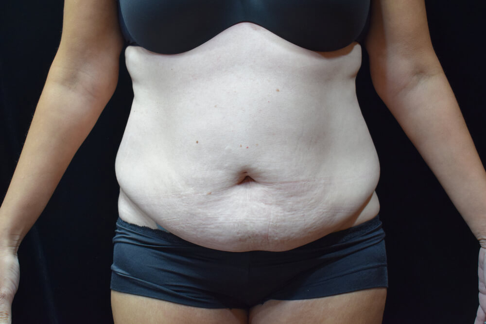 Tummy Tuck (abdominoplasty) - Dr. Joseph A. Racanelli Front view of a person in black underwear showing loose, sagging abdominal skin and an overhanging belly.