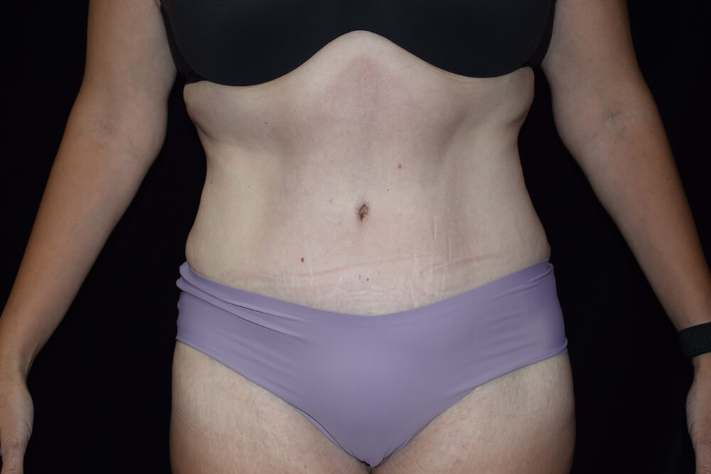Tummy Tuck (abdominoplasty) - Dr. Joseph A. Racanelli Tummy Tuck (abdominoplasty)