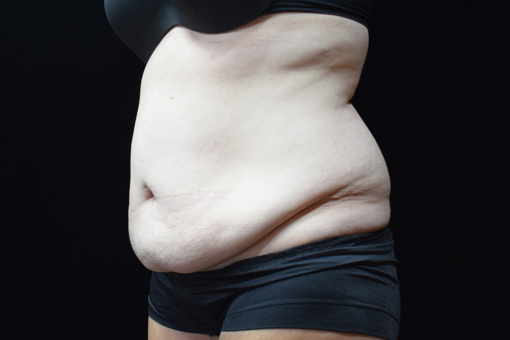 Tummy Tuck (abdominoplasty) - Dr. Joseph A. Racanelli Tummy Tuck (abdominoplasty)