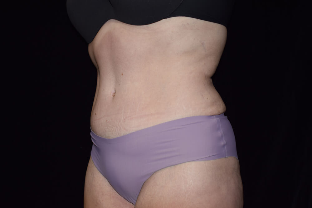 Tummy Tuck (abdominoplasty) - Dr. Joseph A. Racanelli Tummy Tuck (abdominoplasty)