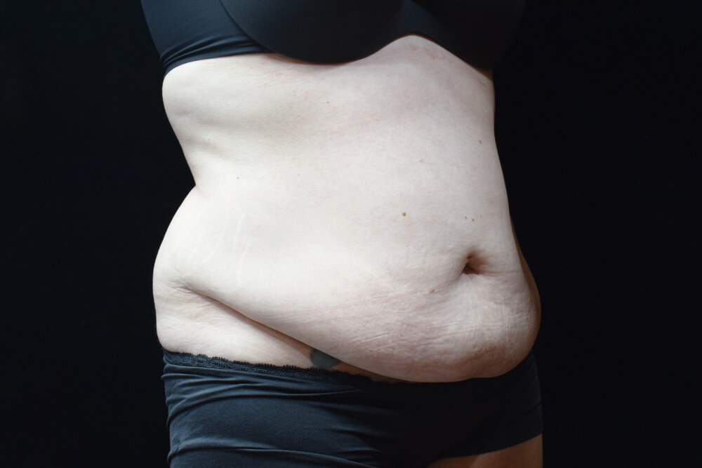 Tummy Tuck (abdominoplasty) - Dr. Joseph A. Racanelli Tummy Tuck (abdominoplasty)