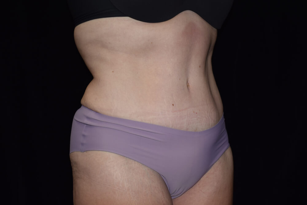 Tummy Tuck (abdominoplasty) - Dr. Joseph A. Racanelli Tummy Tuck (abdominoplasty)