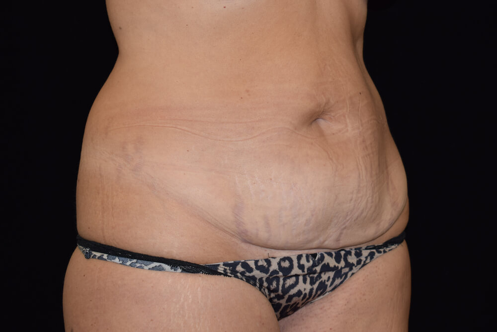 Tummy Tuck (abdominoplasty) - Dr. Joseph A. Racanelli Tummy Tuck (abdominoplasty)