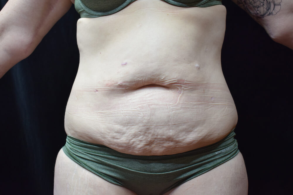 Tummy Tuck (abdominoplasty) - Dr. Joseph A. Racanelli Tummy Tuck (abdominoplasty)